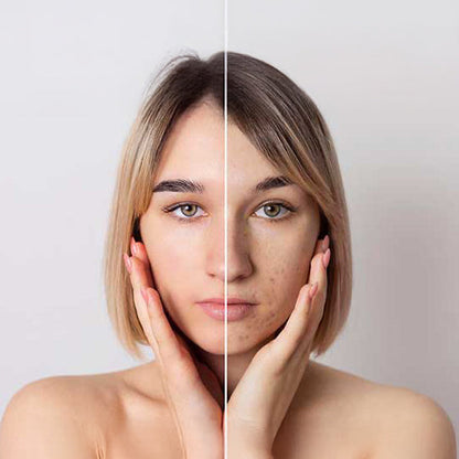 Has Summer left behind Sun Spots, Age Spots or Areas of Pigmentation? Reveal brighter and more even-looking skin with a Mesopeel MD Melanoplus Touch Facial Peel – Only £49 at Illuminate Aesthetics!